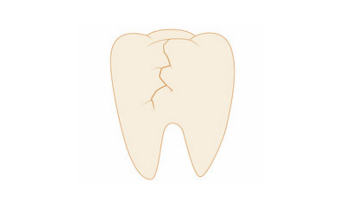 cracked tooth