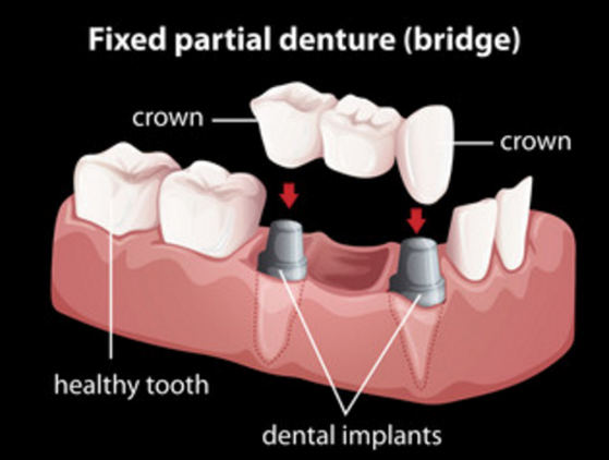 dentures and partial dentures