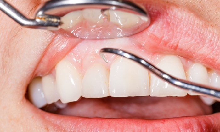 gum disease, periodontal disease