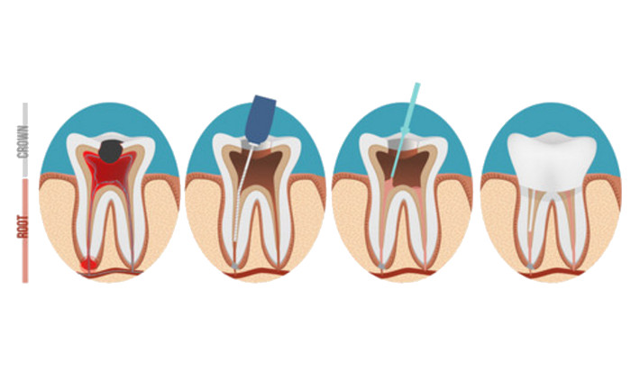 root canal